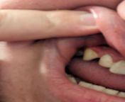 Somewhat painful protrusion on gums from painful