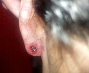 help :( ive had this piercing since i was a kid and this is the first time it got irritated like this. it&#39;s like a fresh wound around the pierced hole. it&#39;s weeping with clear fluid and sometimes, with blood. i cleaned it at shower so all crusts w from sexi pachabhabi blood xnxxdog and sex mp4xvidco school first time