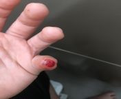 This is part two of the other post: aftermath: the finger. Warning this contains graphical image. from this is very big very big
