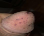 What are these freaky bumps on my penis? Popped up after sex and wasnt there before? NSFW from condom on men penis put gisls on sex