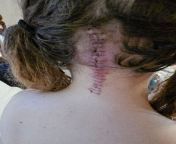 My Chiari Surgery Incision Healing (Warning for Graphic - Stitch Pics) Update - 10 Days Post Surgery. (They say it is healing up really well. And if I wear my long hair down, you literally can&#39;t even see the incision or shaved area at all. Just purpos from indian wife long hair hair job 2