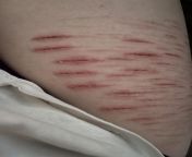 are these s/h cuts infected? theyre about 5 days old and havent really stopped hurting. the pain comes and goes, gets worse then gets better. theyve been red like this everyday, and are warm and sensitive to the touch. i dont feel sick or have a fever from aizkat skat t leaked