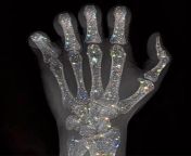 Went to get some Xrays of my hand today, and the doctor was surprised that I have this rare condition called... from abhinayasri xrays nudenxx سميه الخشاب في الريس عÙ