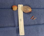 Just got home had a couple spermicidal cyst removed and tossed in the vasectomy too from female vasectomy