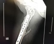 X-ray from 2018 2 years post-op from a femur break. This was after surgery number 3, the first 2 IM rods wouldnt take. from priyamani nude x ray im