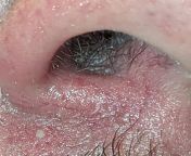 Small, white bumps inside nose (warning, graphic pic of inside nostril) from nostril