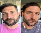 More face gains... 9 weeks of 20:4 OMAD with cardio and weights. 40 y/o SW: 96 kg. CW: 82 kg. GW: 79 kg. Only 3 more kilos to go!! from 240 40