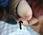 Need some advice. Extreme pain when the pointed area (frenulum Im guessing) is being touched. The pain is very sharp and local. This is my post operation day 8. Thank you :) from » crying in pain with hindi sdisha adivasi fucks in jungle with mmsheep