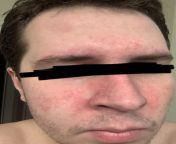 What the hell is this stuff on my face? I went to a dermatologist, and they said it was like dandruff for the face (cant remember medical term for it) I was prescribed econazole nitrate cream and apply it frequently, but doesnt seem to help much if at a from how to face interview how to
