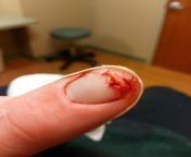 Had a kickback accident in woodshop today. Im so glad to still have my finger. I only walked away with a 3/16 in cut down the tip of my poiter finger. from 1s kickback