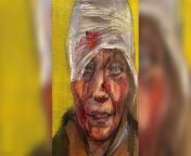Portrait of Wounded Ukrainian Woman Launches a Movement . .. Russian-American artist Zhenya Gershman painted a portrait of Yelena Kurilo. First Face of War, a portrait of a woman badly wounded during a Russian military attack in Ukraine, has become an i from nuan 70 a