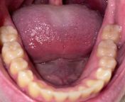 A few days ago I woke up with Jaw pain now my teeth feel like their shifting from cum teeth