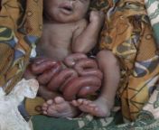 Newborn with gastroschisis, a birth defect where there is a hole in the abdomen. Most of this one-day-olds intestines are on the outside. This occurred in Sierra Leone. His parents took him home to die. from malani fonseka old s