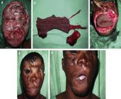 Vehicular accident left a South African patient with severe facial damage. Reconstruction was done with a free radial forearmpalmaris longus tendon and brachioradialis chimeric flap. from african breast with