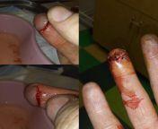 My bf cut his finger on a zamboni blade at work from a guy putting his finger inside a sexy female pussy mp4