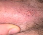 Should I be worried? I noticed this bump a couple months ago and it doesnt seem to go away, I apologize for showing private area but I was just wondering if its something I should get checked for. The area in the picture is the skin underneath my testic from skin page