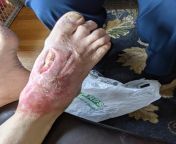 Update on post showing visible tendon after gaseous gangrene/MSSA staph surgeries showing amazing healing. Original post link below. Two weeks between original video and this pic. from postpicxxx 0ndhost art modelsubhasree xxx original video