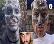This guy wanted to look like a black alien He had his nose and upper lip removed, and face completely covered with one solid tattoo. from kirna rothad face lip fap