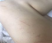 Hello everyone, my sexual partner is coming home in a week and I need these to be GONE by then. Any suggestions? I thought about blaming them on the cat but theres about 15 of them and only on my right thigh and I doubt hes that stupid from indian aunty massage penis in massage parlourhabhi and dev
