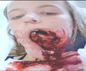 This poor 15yo girls horse bolted and she flew off and landed face first on a metal fence post. Jaw hung on by 1cm of skin apparently. Ouch. from skinny girl fucks fence post