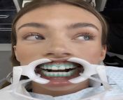 Famous model wearing a dental mouth retractor. from cheek retractor