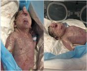 Newborn with cyclopia, a rare and lethal birth defect. This baby has one eye in the center of its forehead and a probiscus but no nose. It died 13 hours after birth. from rape after birth