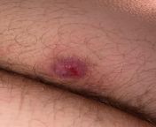 Painful open wound in buttcrack? My boyfriend has had this for years and refuses to get it looked at. It seems to heal/get smaller sometimes but if it gets rubbed it opens back up and its painful for him to walk. It never fully goes away. Anyone know wha from painful