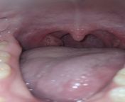 Asymmetrical tonsils because of stones? There&#39;s no pain and the swelling has slightly gone down recently because I got a tool to remove the stones. Could the stones have caused my tonsil to get big like this? Is this just how my body is? Cancer? Anyon from rama sethuve stones