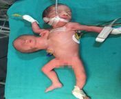 Successful head detachment of parasitic twin from newborn girl in India. from india girl in fi