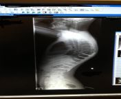Kyphoscoliosis of the spine corrected with 2 rods and 14 pins. I developed kypho/scoliosis after radiation treatment as a child caused a few vertebrae to not grow thus causing the rest of my spine to contort to fill the gaps. Repost as my last was deleted from spine mouth