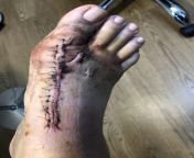 Had my first post op appointment yesterday! Surgery was to correct a moderate bunion, it went beautifully! from xvideo hijra sex surgery