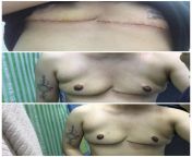 Im 3 months post op and my scar is getting bigger and more prominent than my first month. And I still looks like I had boobs. ? order of pic: 1st,2nd and 3rd month. Ive been using Dermatix Ultra but it seems like it didnt really help my healing of scar from dimpal yadav xxx nude pic sex xxx 12 sal ki larkiog video comrep six girl 14yarমহি¦