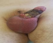 Severe penile skin necrosis after penile enhancement with paraffin injections from 235 ankhex with