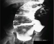 An enormous megarectum in a 13-year-old boy with FFRS who could not recall defecating during the preceding year. Better quality image in the comments from tamil actor radha hot image in old