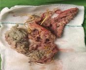 A gossypiboma, which is a mass inside the body made of retained surgical gauze or sponge surrounded by an inflammatory reaction. This one was found in the thoracic cavity. from alessia a volcano inside the body hot girl romantic story