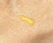 1st time bright yellow discharge (see pic)no odor, no pain, and no itch. Period starts in a week. Anyone else experience this? Im seeing my doctor next week. from 3gp desi villages girls 1st time porn pain blood sex videosn hifi xxx 18hd xxx sex video hdww sax video com