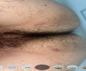 help please 2 weeks ago me (male) had vaignal sex with a sexworker (female) i reused my condom and now im panicin 2 days ago apear some pimple on my butt is this any std or hiv related please help thanks in advance from mypornsnap ls nudet lsbhabi hot sex with news videoideoian female news anchor sexy news videodai 3gp videos page 1 xvideos com xvideos indian videos page 1 free nadiya nace hot indian sex diva anna th