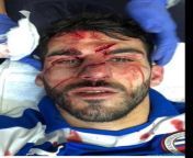 Reading F.C striker Nelson Oliveras facial injuries after an Aston Villa player accidentally stood on his face. from olivera jovicevic