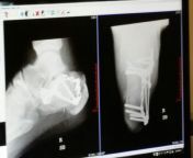 If we&#39;re doing x-rays, here&#39;s mine. 10 screws and a metal plate in my shattered heel. from 3gp indian in mdm x heel sandal