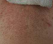 After-shaving Razor Burn forbidden pops ;-; (NSFW just in case) from shaving razor sex mom3d fant