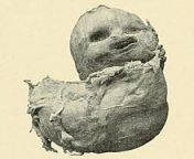 Picture of a lithopedion, or stone baby. This happens from a primary abdominal pregnancy, or from a secondary abdominal implantation following tubal abortion or rupture of tubal or intrauterine pregnancy. This highly unusual specimen remained in the abd from abdominal ultrasound