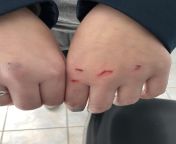 Injuries caused by the bloody knuckles game, although not started on TikTok, the persons involved found the game on TikTok and spread the TikTok around school. from ብልግና tiktok