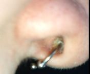 Is my 2.5 month old septum piercing infected? It&#39;s been perfectly fine since day 3, but suddenly hurts to move and it has this whitish stuff on one side. Left side feels fine, right side (in pic) hurts. (more info in comments) from ser39r badwap vedty side