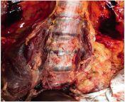 Simons sign in a case of hanging death. Simons sign is a hemorrhage in the anterior aspect of the intervertebral discs of the lumbar region that can be observed in hangings and other traumatic deaths. from sign in
