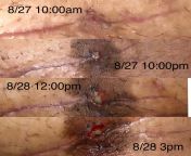 Dr put silver nitrate on wound. No pain/smell. Wait til mon or go to er? from dr amarjit singh view on dasam granth