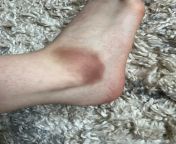 Ankle from cutegirl sprain ankle