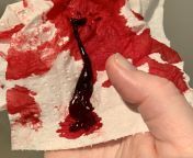 Had what can only be described as cervical contractions, only moments apart when I finally gushed out blood &amp; birthed this gummy worm of a clot (thumb for scale) from asmr gummy worm sucking