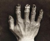 Hand belonging to an X-ray technician in 1900 at the Royal London Hospital, which shows the damage from radiation exposure. from sneha ray nude in sare