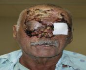 Ronald Poppo after being attacked by Rudy Eugene in 2012. Eugene removed most of Poppos face by biting him from eugene teo shoulder