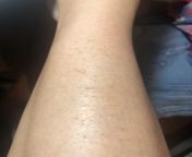 I had small, itchy bumps on my shin. They dont itch anymore but look like scabs now. Is it a rash? from 2173860 micchi hatogaya misae nohara shin chan